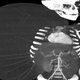 Illustration for article titled Two-Year-Old Has Giant Tumor Removed That Weighs More Than He Does